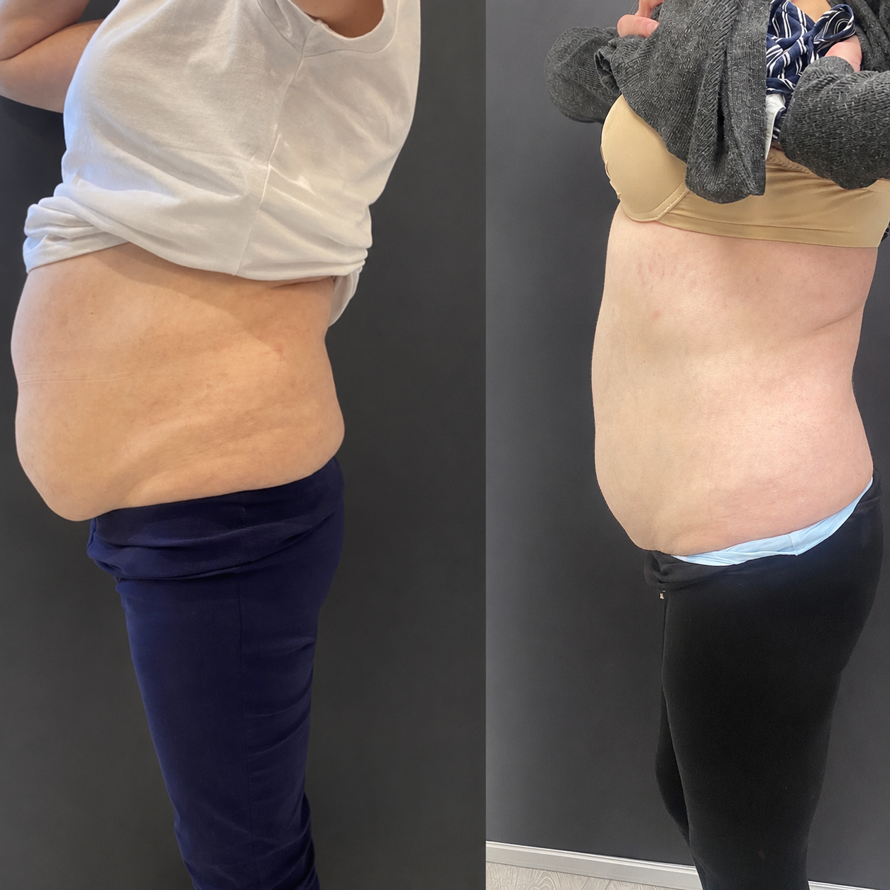 Result – Midsection Sculpt